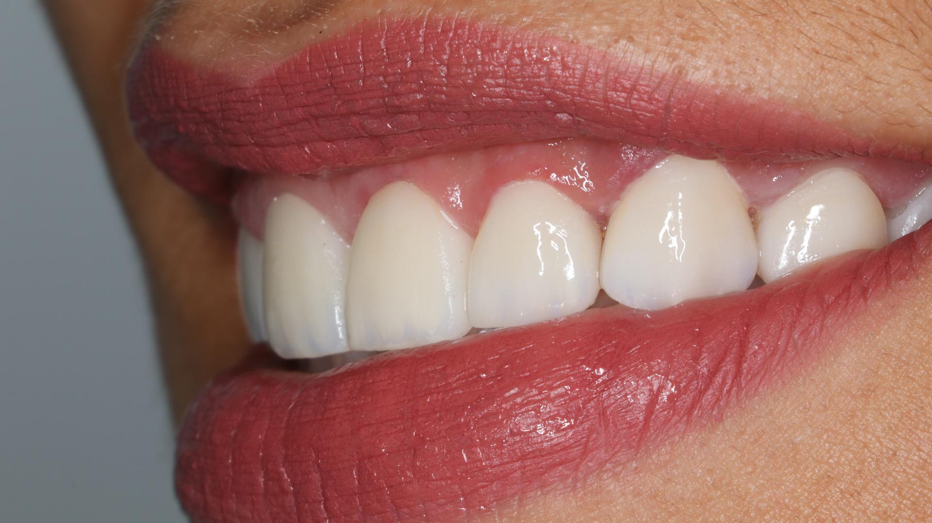 Resultado Keila — Sonrisa lateral